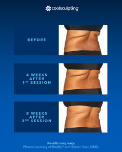 coolsculpting-before-after-photo-1