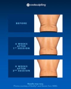 coolsculpting-before-after-photo-2